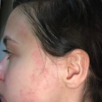 Gratis Claderm Kil Maskesi Alerji Yapıyor