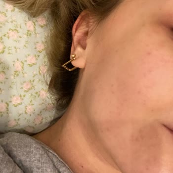 Sinoz C Vitamini Yüzümü Mahvetti!