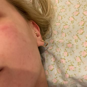 Sinoz C Vitamini Yüzümü Mahvetti!