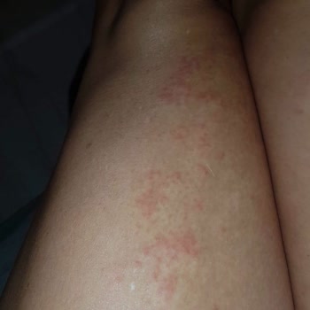 Bionep Güzellik Merkezi Bacak Ve Kol Lazer Yanığı