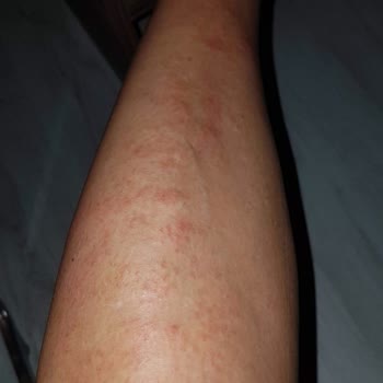 Bionep Güzellik Merkezi Bacak Ve Kol Lazer Yanığı