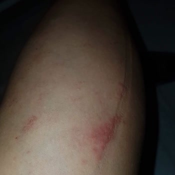 Bionep Güzellik Merkezi Bacak Ve Kol Lazer Yanığı