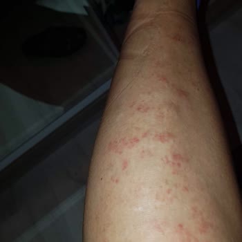 Bionep Güzellik Merkezi Bacak Ve Kol Lazer Yanığı