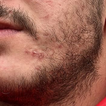 Esse Güzellik Salonu Yüzümü Yara Yaptılar