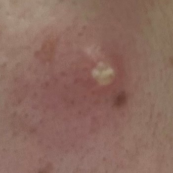 La Roche Ürünleri Sivilce Oluşturdu