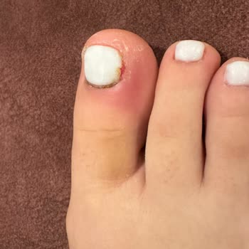 Hazal Akbay Beauty Parmağım Ağrıyor İltihaplanma