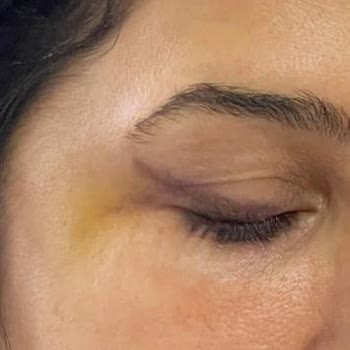 Dr. İhsan Başaran Göz Altı Işık Dolgusu