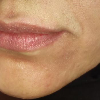 Procsin Marka Ürün Complex Solution 20 Ml Yüz Yakıyor Ciddi Bir Şekilde