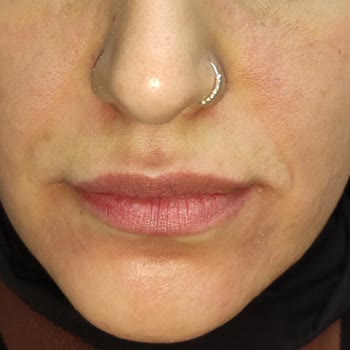 Procsin Marka Ürün Complex Solution 20 Ml Yüz Yakıyor Ciddi Bir Şekilde