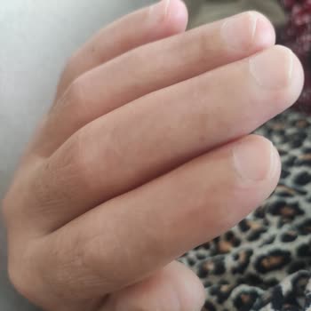 Bağcılar Eğitim Ve Araştırma Hastanesi Asistanların Sebep Olduğu Alçı Sonucu Elin Kullanılamaması!