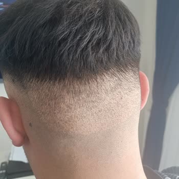 Liv Hospital Saç Ekimi Ve Kalan İz