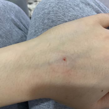 Lilyum Tıp Merkezi Laborant Personelinin Kan Alamaması