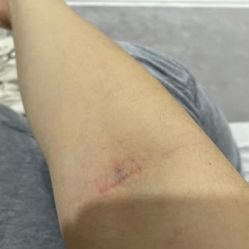 Lilyum Tıp Merkezi Laborant Personelinin Kan Alamaması