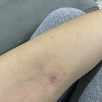 Lilyum Tıp Merkezi Laborant Personelinin Kan Alamaması