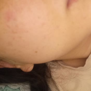 Dermoskin Tonik Yüzümde Sivilce Yaptı