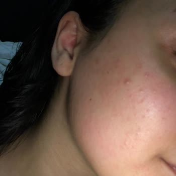 La Roche Posay Effaclar Yüz Yıkama Jeli, Tonik Ve Güneş Kremi Kullanımı Sonrası Oluşan Alerji Ve Sivilceler