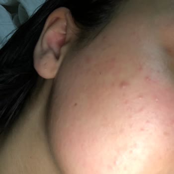 La Roche Posay Effaclar Yüz Yıkama Jeli, Tonik Ve Güneş Kremi Kullanımı Sonrası Oluşan Alerji Ve Sivilceler