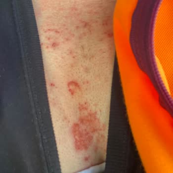 Veet Tüy Dökücü Krem Alerji Yapıyor