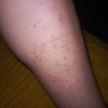 Veet Tüy Dökücünün Ağır Cilt Tahrişine Sebep Olması