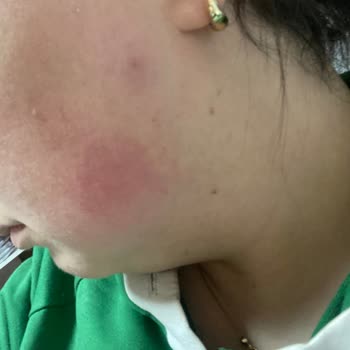 Simple Skin Care Nemlendirici Ve Hyaluronik Asit Serum Cildimi Yakıyor!