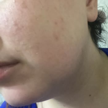 Simple Skin Care Nemlendirici Ve Hyaluronik Asit Serum Cildimi Yakıyor!