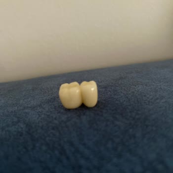 Kardent Ağız Ve Diş Sağlığı Polikliniği Diş İmplantı Protezinin Çıkması!