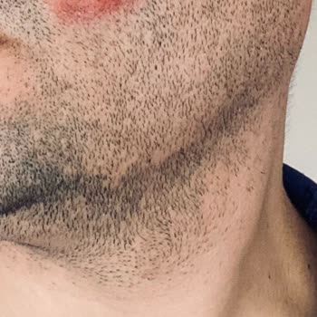 Suit Güzellik Merkezleri Yüz Yanığı