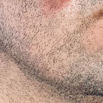 Suit Güzellik Merkezleri Yüz Yanığı