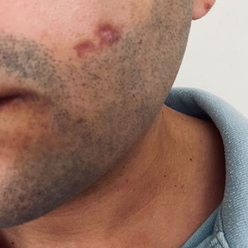 Suit Güzellik Merkezleri Yüz Yanığı