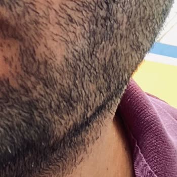 Suit Güzellik Merkezleri Yüz Yanığı