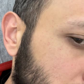 BİM Soğuk Pizza Gıda Zehirlenmesi