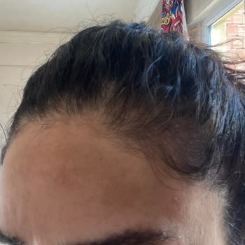 Dr. Neslihan Dolar Lazer Tedavisi Leke Tedavisi