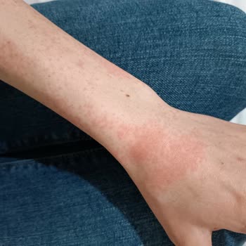 Agiss Tüy Dökücü Sprey 5 Dakika Bile Bekletmediğim Halde Kolumu Yaktı!