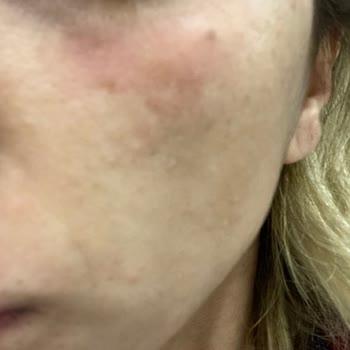 Maruderm Maruz-derm Serum Resmen Yüzümü Yaktı