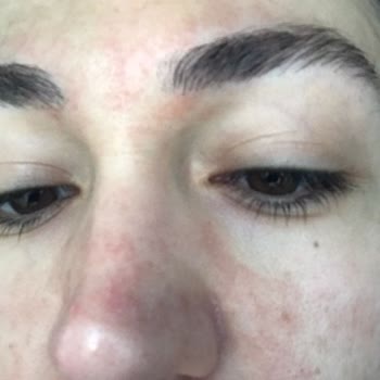 Bioxcin Güneş Kremi Alerji Yaptı