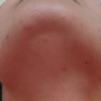 Cream Co Sivilce Ve Komedon Yaptı