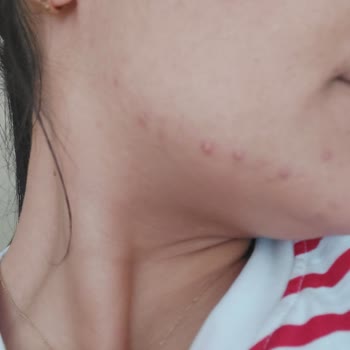 Cream Co Sivilce Ve Komedon Yaptı