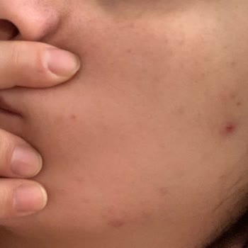 Estelia Vip Güzellik Merkezi BB Glow Ve Dermapen Mağduruyum