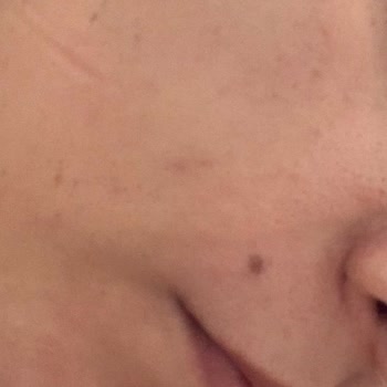 Estelia Vip Güzellik Merkezi BB Glow Ve Dermapen Mağduruyum