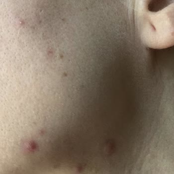 The Purest Solutions Ürünün Yan Etkileri