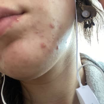 Yves Rocher Krem, Serum, Tonik Yüzümü Mahvetti