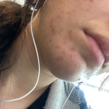 Yves Rocher Krem, Serum, Tonik Yüzümü Mahvetti