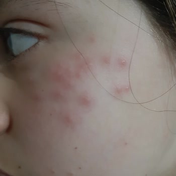 Pastel Kozmetik Yüzüm Benek Benek Oldu