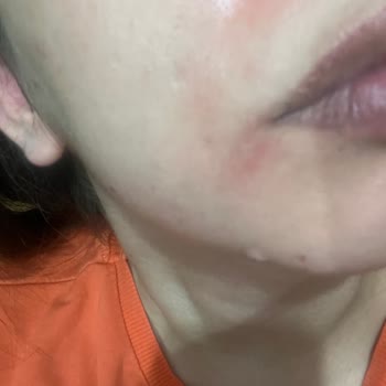 Loreal Hyaluron Yüz Temizleme Jeli Yüzümü Mahvetti