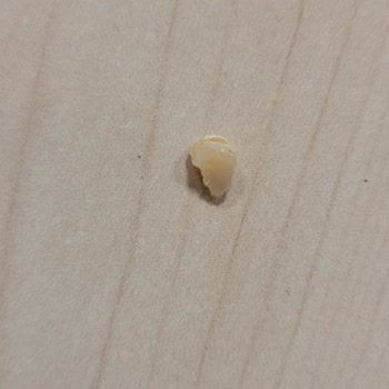 Alyadent Ağız ve Diş Alyadent Diş Kliniğinde Yaptırdığım Dolgu Düştü