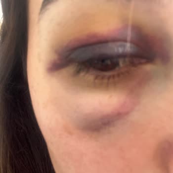 Medical Park Hastanesi Göz Bölümünün Memnuniyetsiz Çalışması