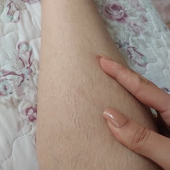 Küçükköy Özel Bilge Hastanesi'nde Lazer Epilasyon Hizmeti