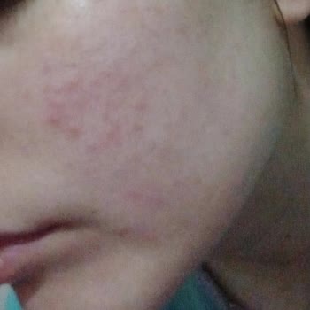 Licape Kozmetik Yüzüm Sivilcelendi Kabarmaya Başladı Cilt Bariyerim Mahvoldu