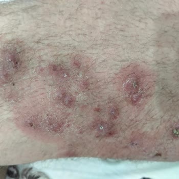 Sağlık Bakanlığı 20 Yaşındayım Ve Uyuzdan Dolayı Canıma Kıymak İstiyorum!