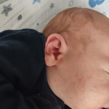 Mustela Şampuan Yenidoğan Alerji